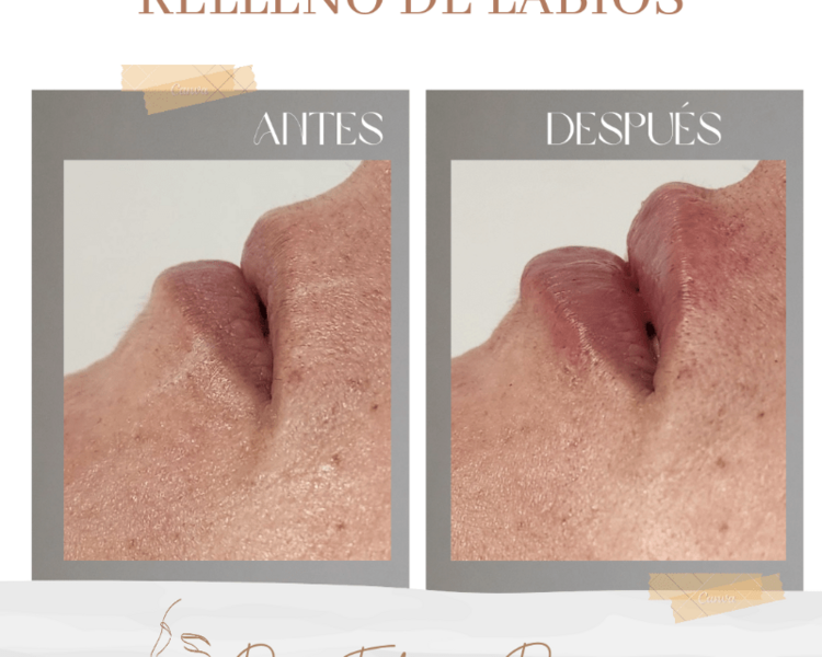 Armonización de labios