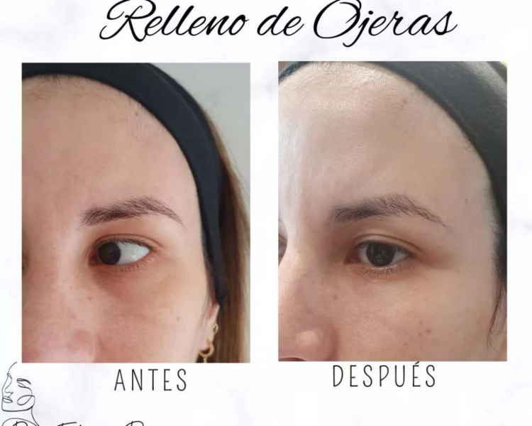 Relleno ojeras