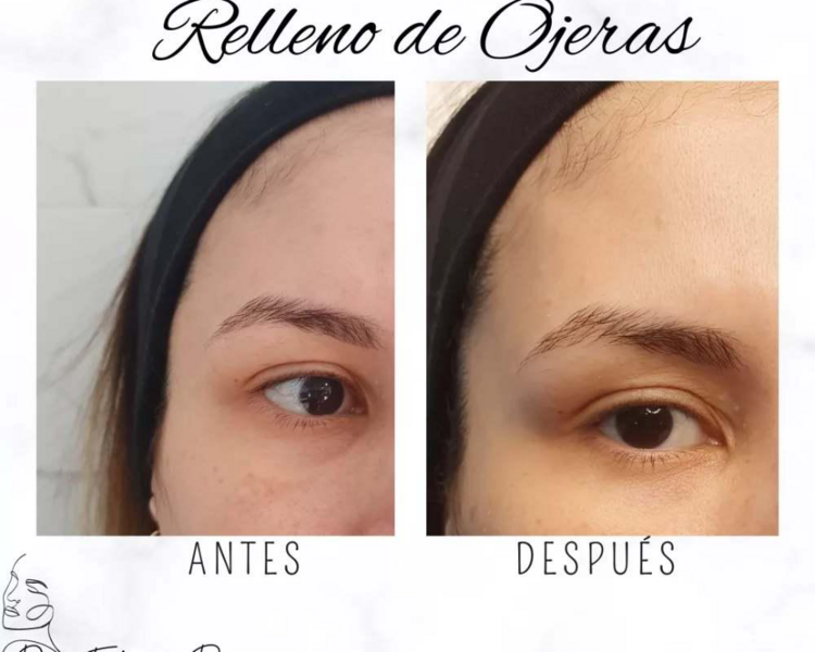Relleno ojeras