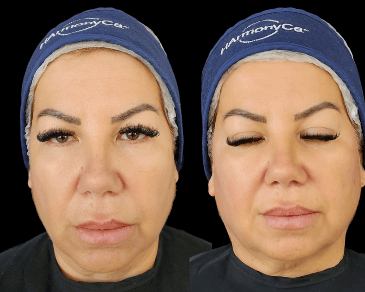 Bioestimulación Harmonyca