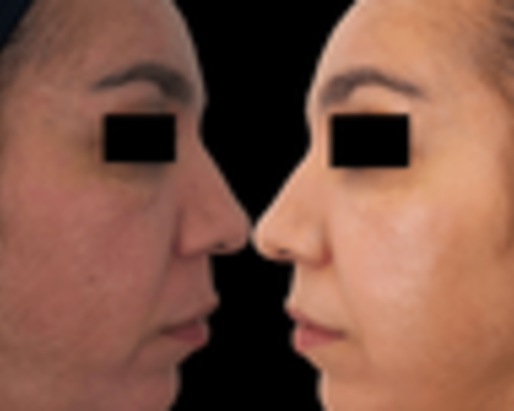 Vitaminas c/ dermapen 3 sesiones