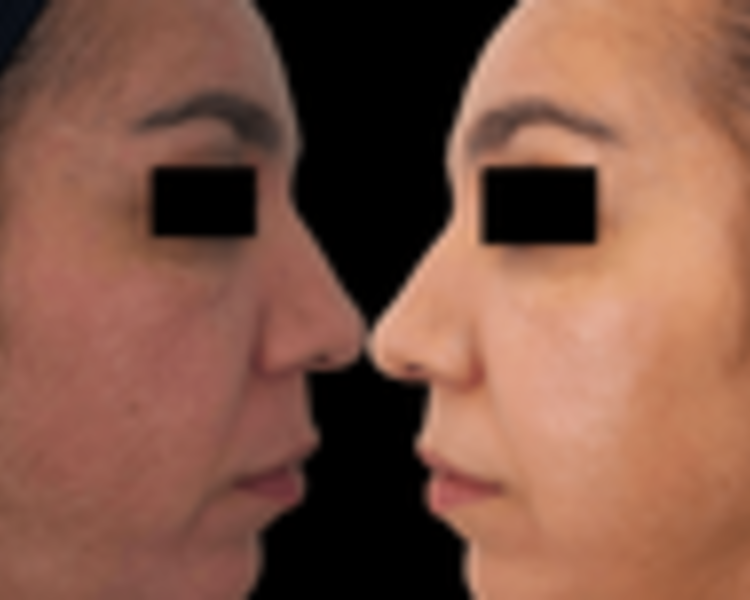 Vitaminas c/ dermapen 2 sesiones