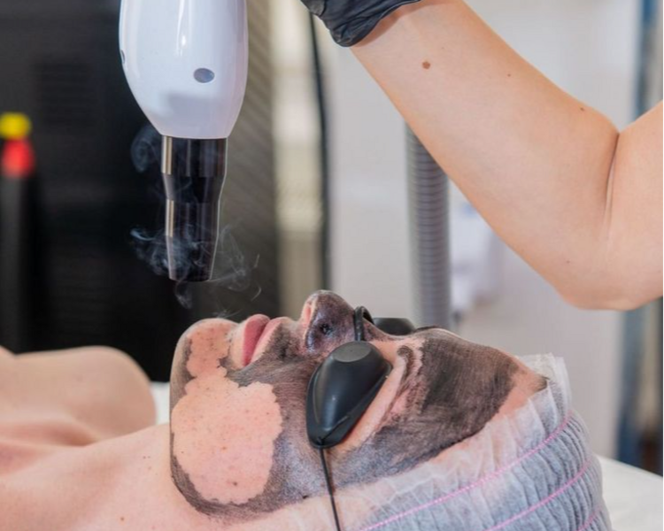 Hollywood peeling 1 sesión 