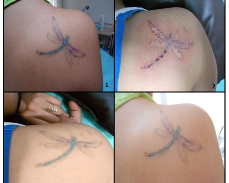 Remoción de tatuajes -5