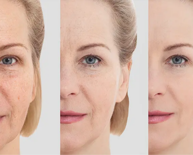 Protocolo Redlift - El mejor y más duradero efecto lifting