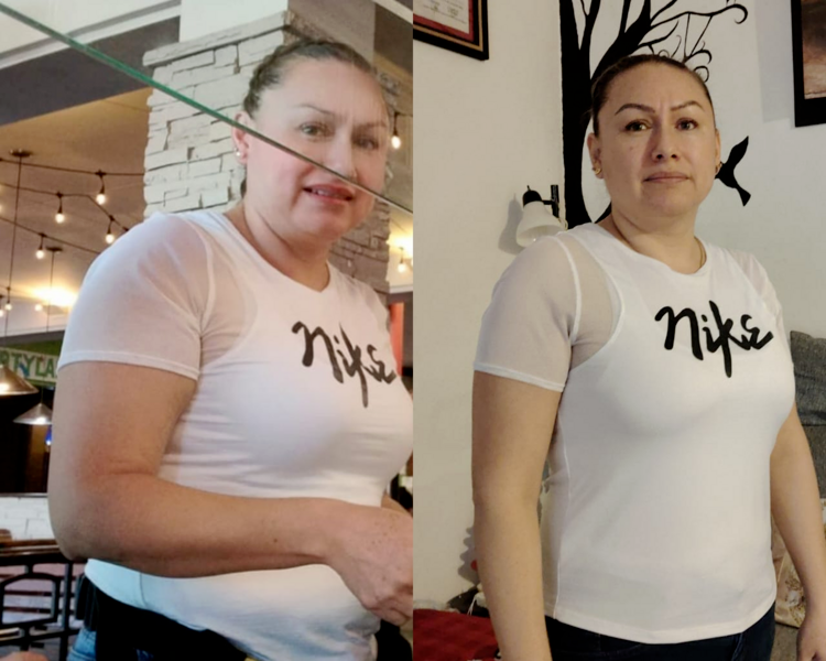 CARBOXITERAPIA CORPORAL