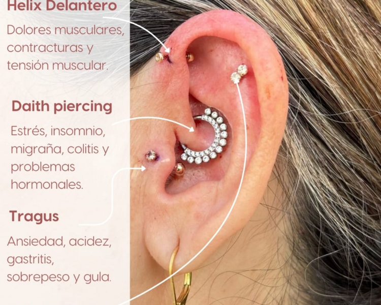 PERFORACION TERAPEUTICA