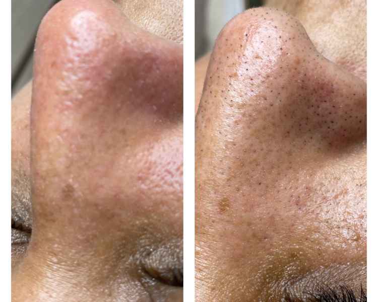 limpieza facial premium 