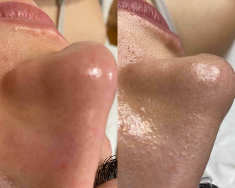 limpieza facial premium 