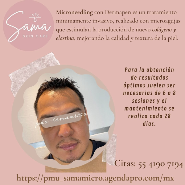 Rejuvenecimiento | Piel seca | Flacidez con Microneedling (6 sesiones con dermapen)