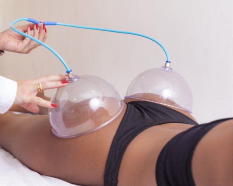 Voluminizacion de glúteos con copas 