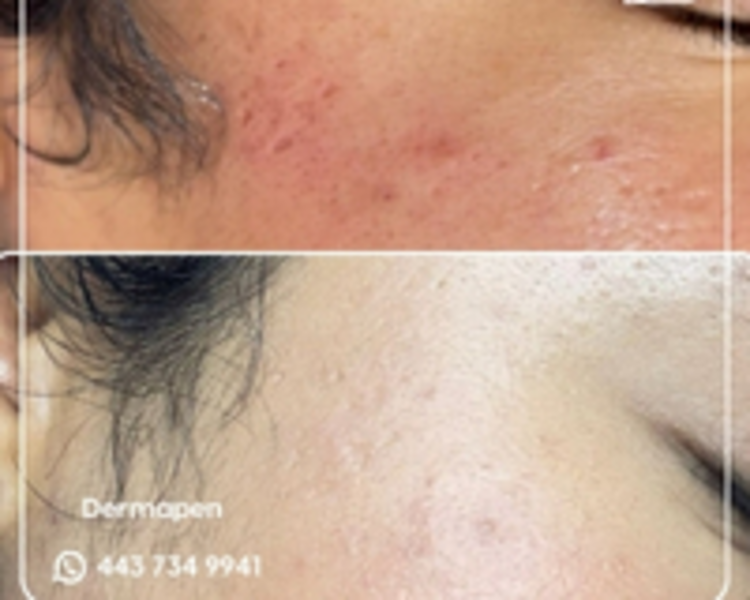 DERMAPEN CON ACIDO HIALURONICO