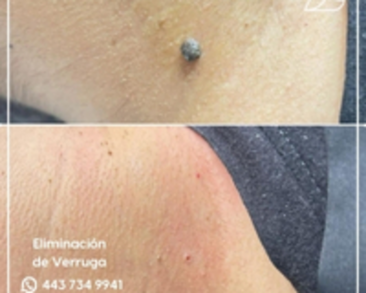 ELIMINACION DE VERRUGAS Y MEZQUINOS