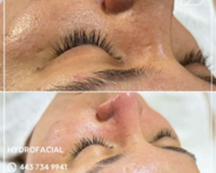 HIDRAFACIAL