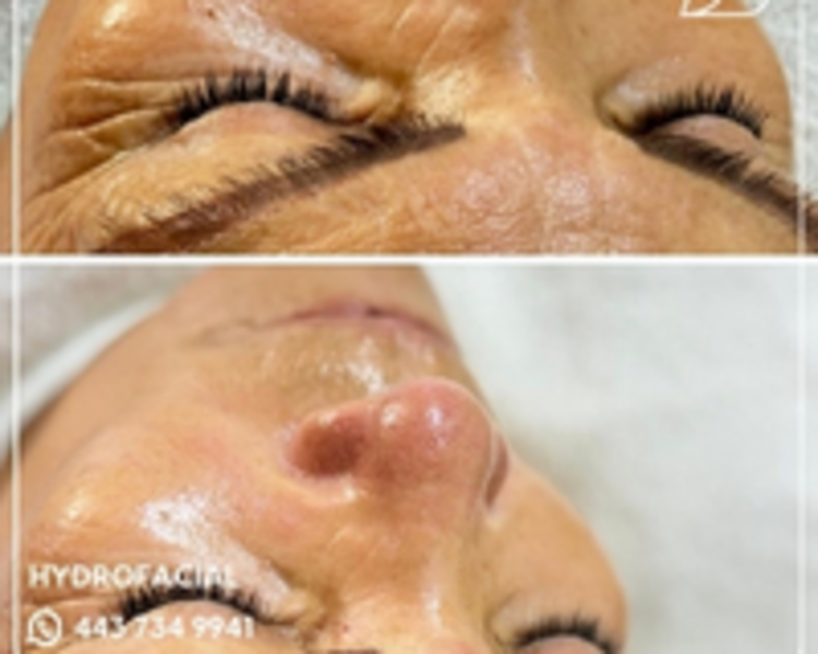 HIDRAFACIAL