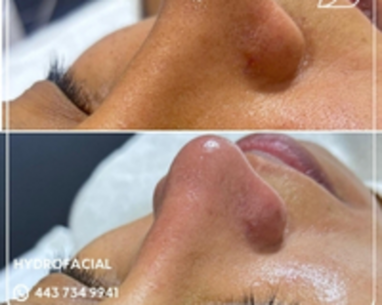 HIDRAFACIAL