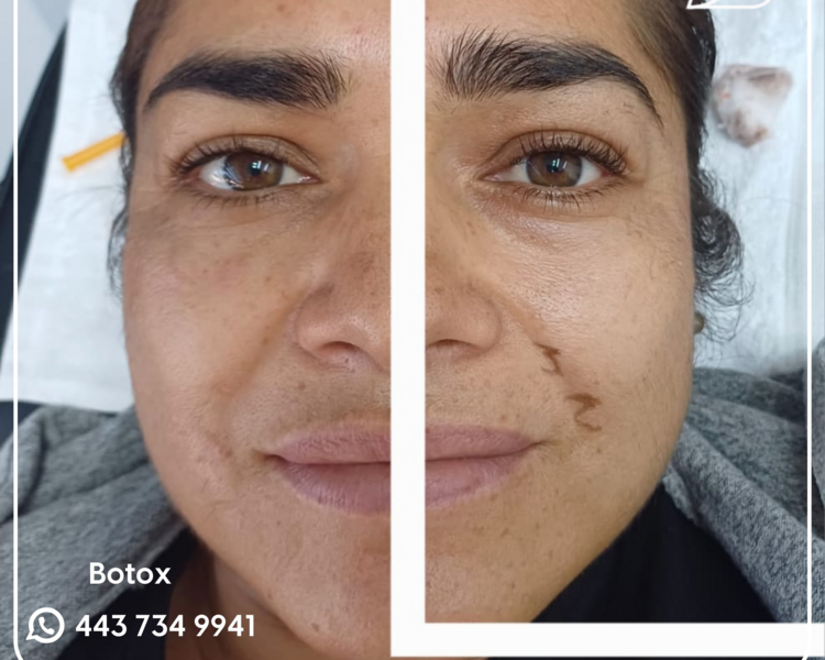 BABY BOTOX