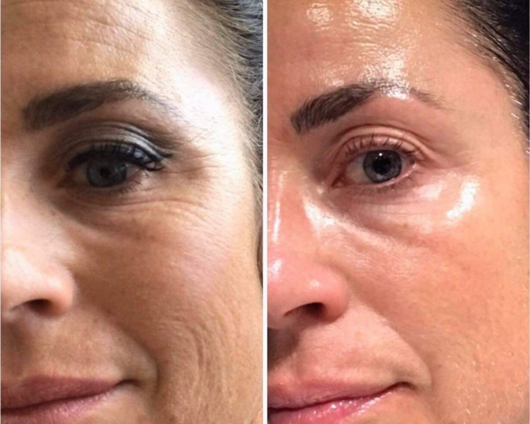 drenaje linfatico facial