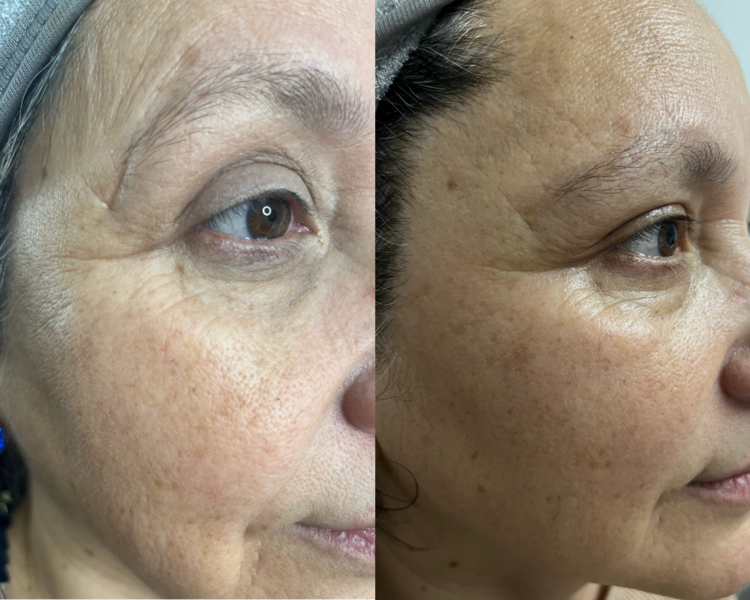 tripollar facial (radiofrecuencia pollogen )