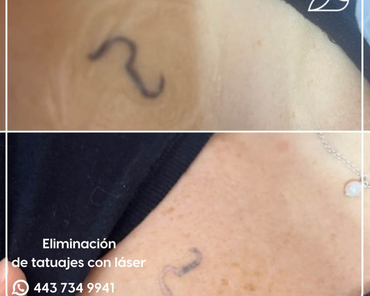 ELIMINACION TATUAJE PERSONALIZADO