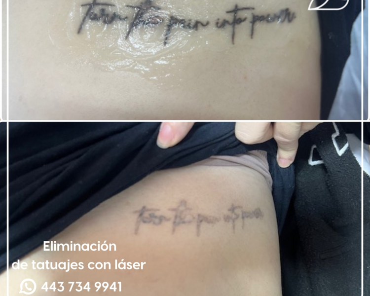 ELIMINACION TATUAJE PERSONALIZADO
