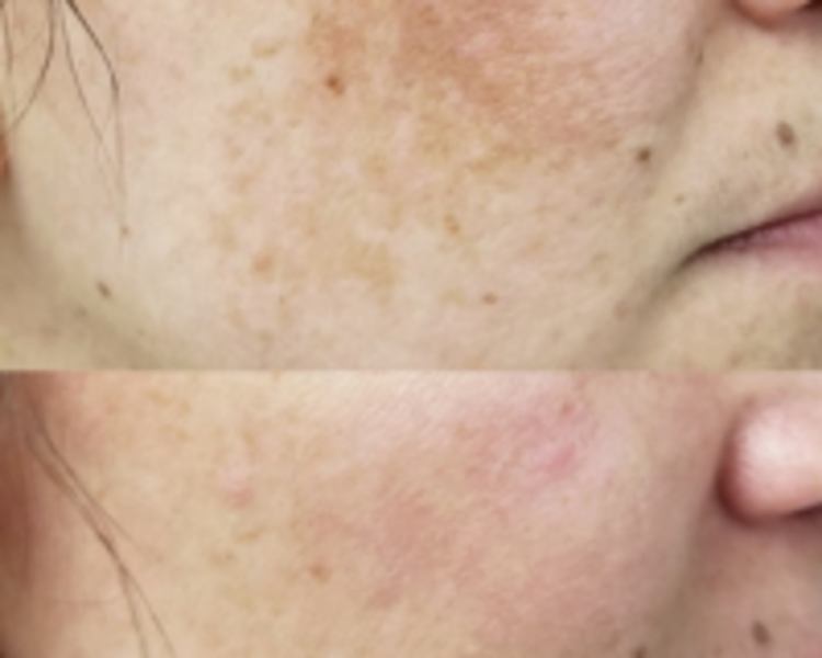 Despigmentante (manchas solares o melasma)