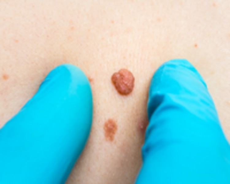 ELIMINACION LUNARES Y VERRUGAS -DESDE