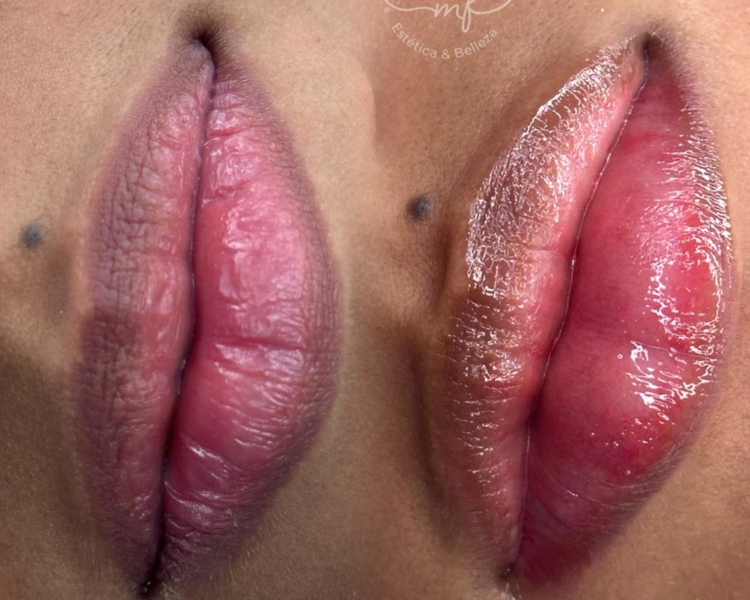 Hidratación de labios (1 Sesión)