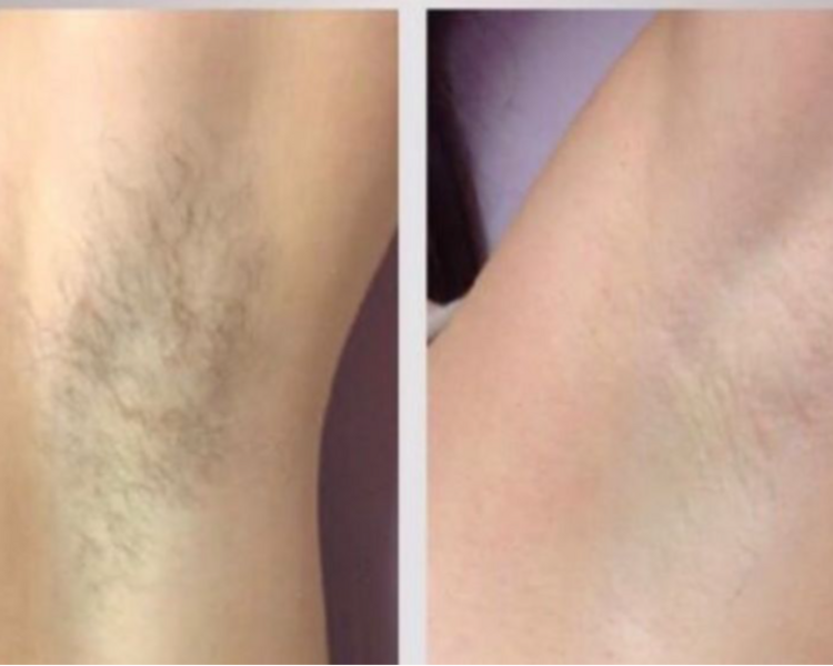 Depilación Progresiva Zona Mediana