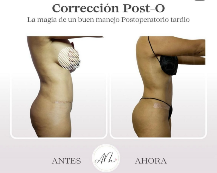 Corrección Postoperatorio