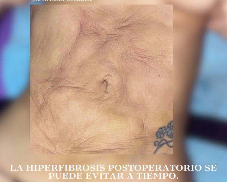 Hiperfibrosis Postoperatoria