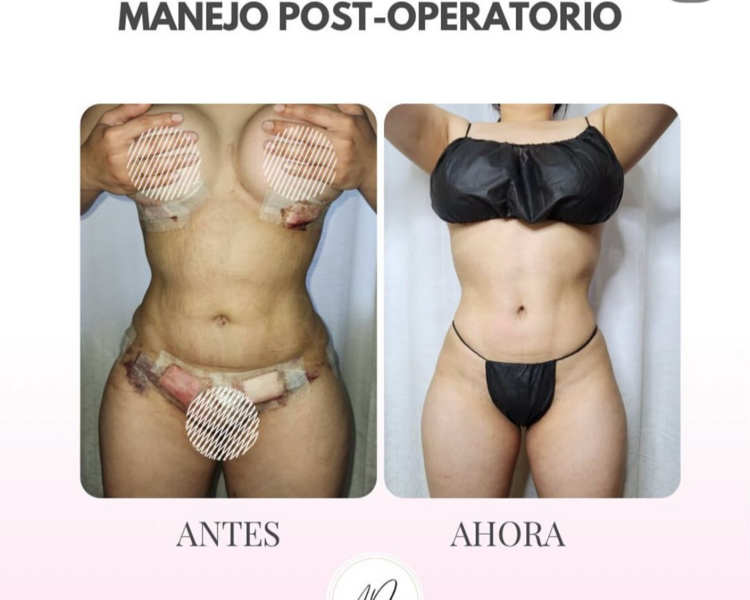 Postoperatorio Reciente