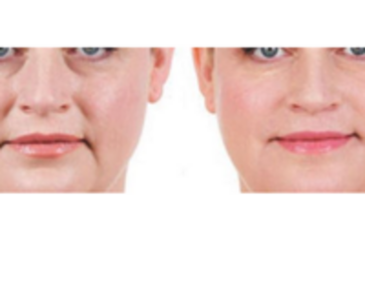 HIDROXIAPATITA -DESDE