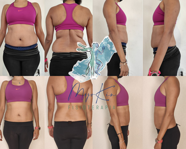 Electrolipólisis Dermatofuncional