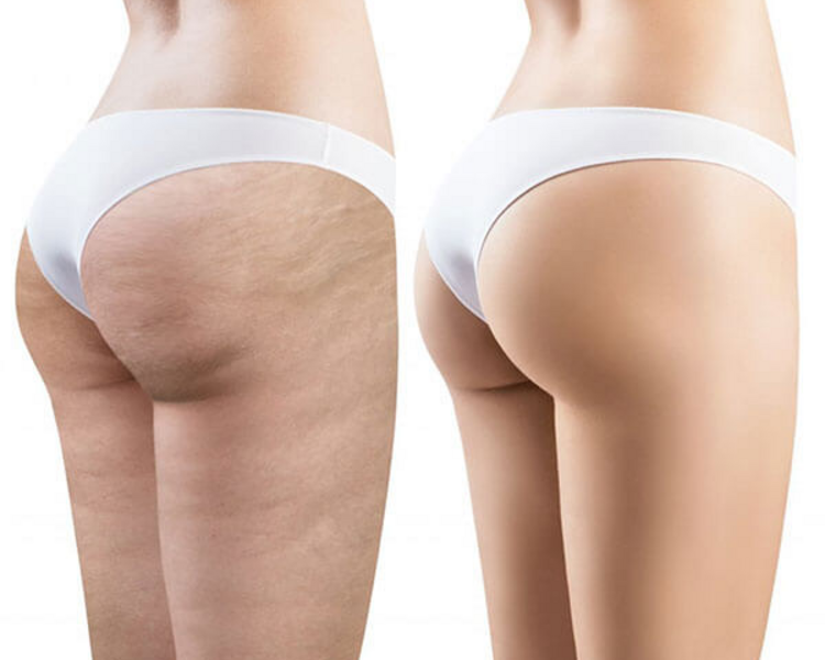 ANTICELULITIS FLASH x6