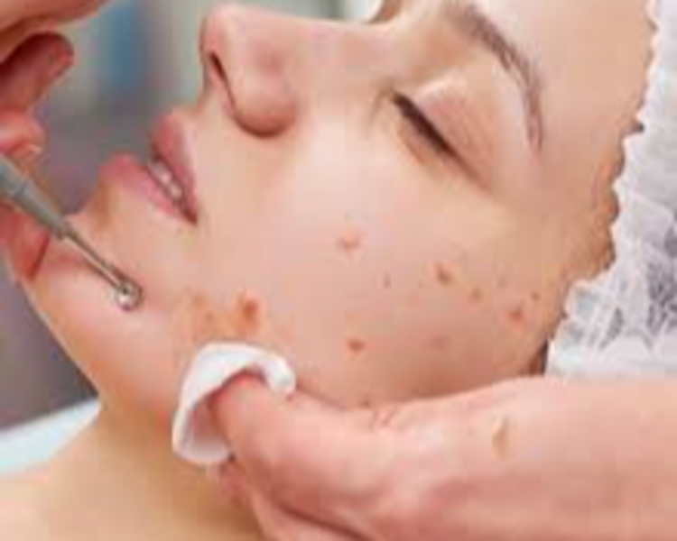 LIMPIEZA FACIAL ANTI ACNÉ 