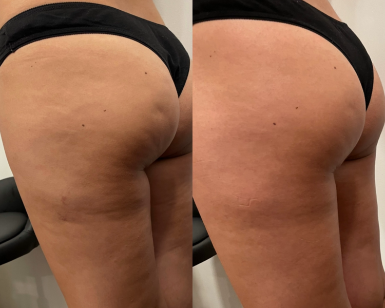 sesión individual maderoterapia cuerpo completo