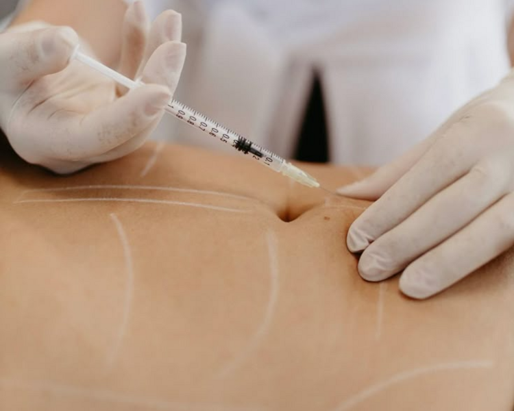sesión individual lipoescultura sin cirugia intensivo