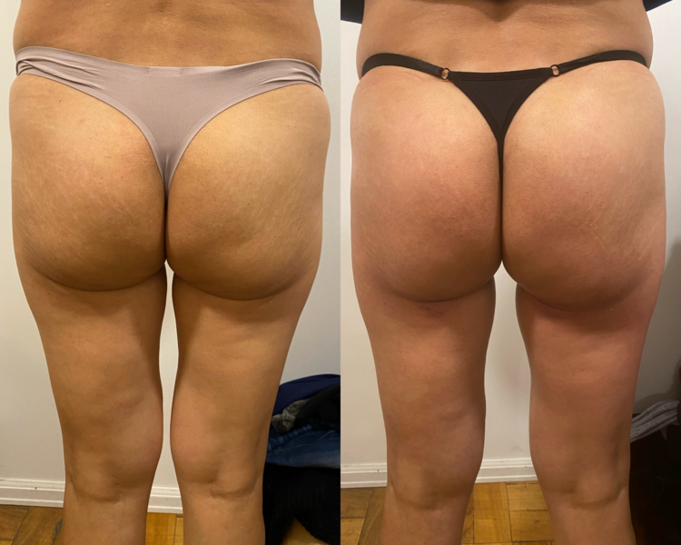 levantamiento de gluteos 12 sesiones 
