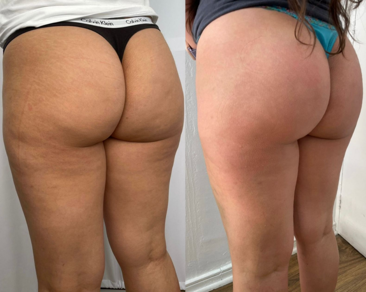 levantamiento de gluteos 12 sesiones 
