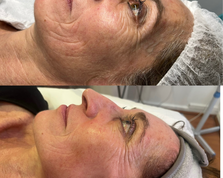 tripollar facial (radiofrecuencia by pollogen) pack 6 sesiones 
