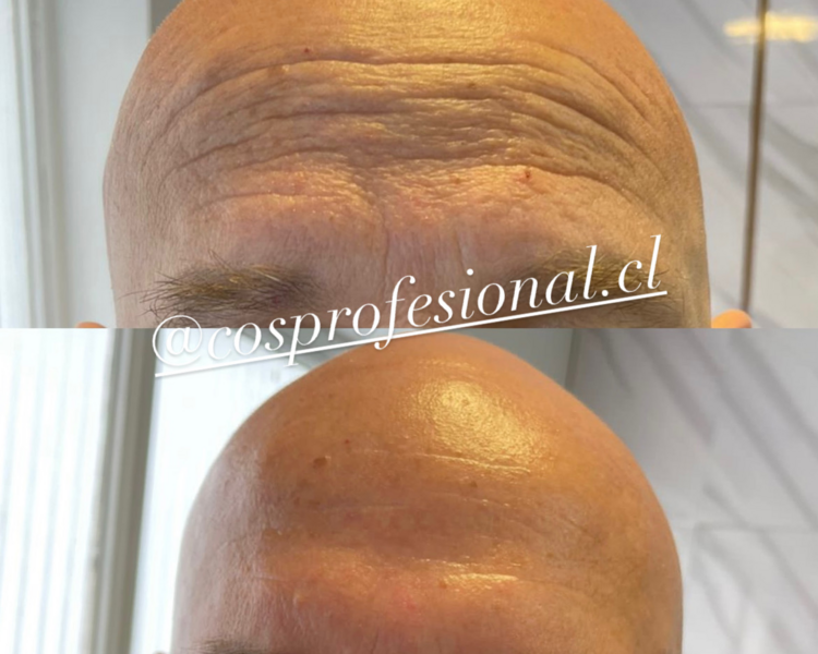 tripollar facial (radiofrecuencia by pollogen) pack 6 sesiones 