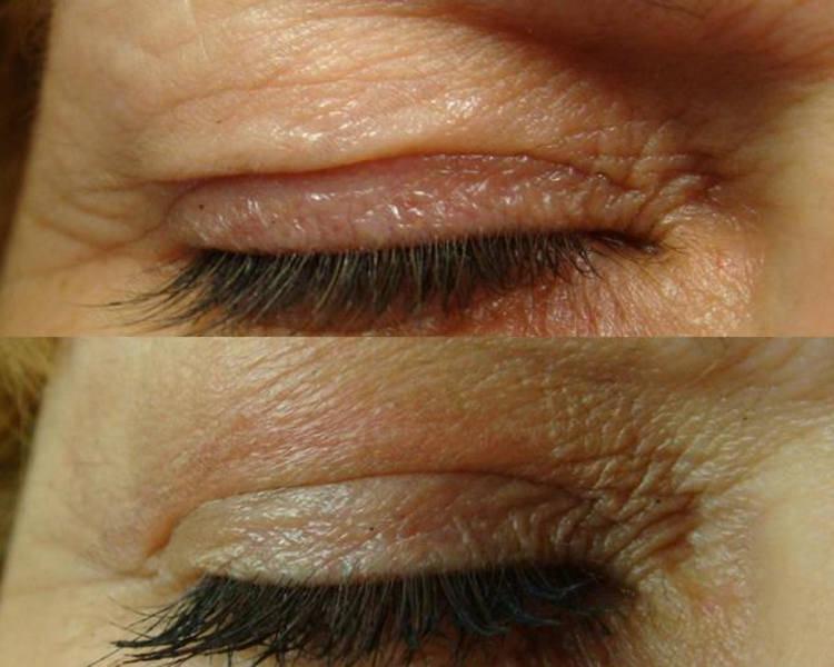 Rejuvenecimento de Parpados