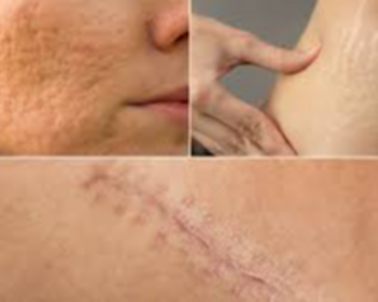 Tratamiento para cicatrices 