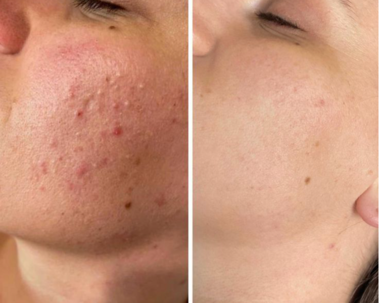 Limpieza facial acne