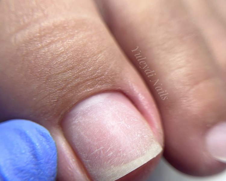 Retiro Semipermanente en Pies