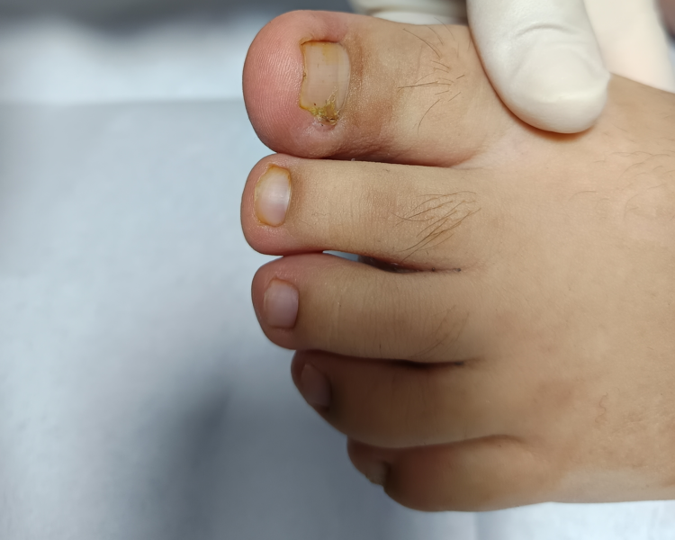 Onicocriptosis o uña encarnada niños hasta 12 años