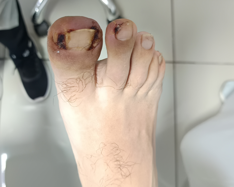 Onicocriptosis o Uña encarnada Adultos