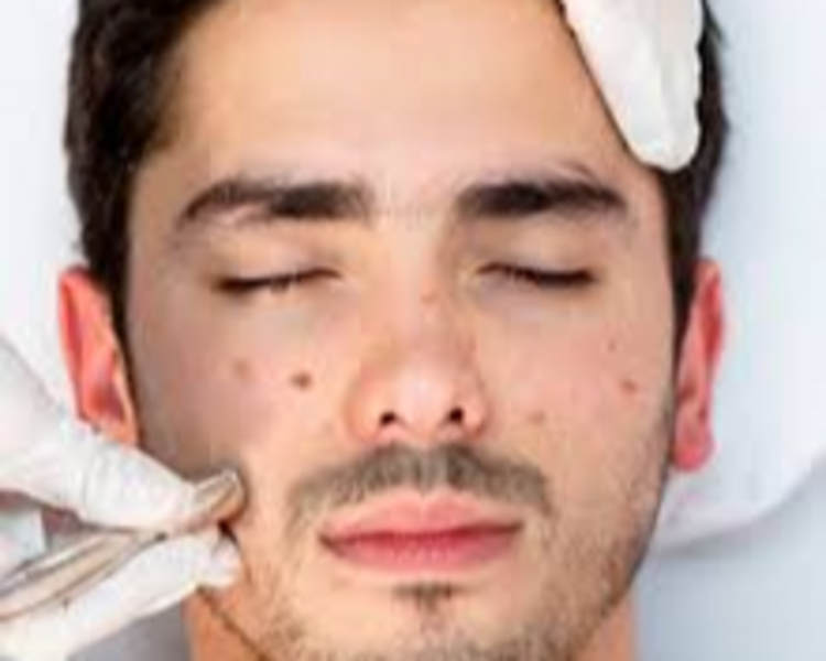 Limpieza facial tratat. Acné