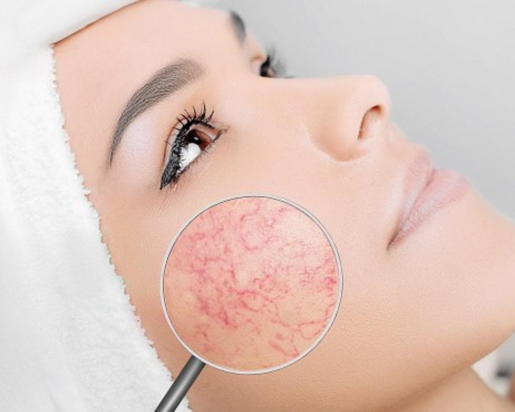 Limpieza facial trat. rosacea